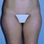 Liposuction Before & After Patient #4833