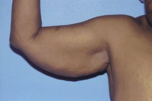 Brachioplasty Before & After Patient #4828