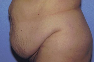 Tummy Tuck Before & After Patient #4850