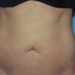 Liposuction Before & After Patient #4843