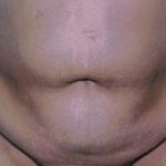 Tummy Tuck Before & After Patient #4862