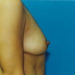 Breast Augmentation Before & After Patient #4927