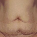 Tummy Tuck Before & After Patient #4869