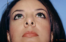 Rhinoplasty Before & After Patient #4803