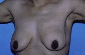 Breast Lift Before & After Patient #5026