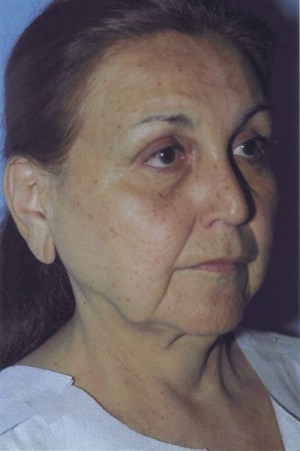 Facelift / Blepharoplasty Before & After Patient #4768