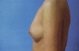 Breast Augmentation Before & After Patient #4941