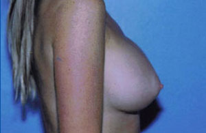 Breast Augmentation Before & After Patient #4941