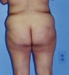 Tummy Tuck Before & After Patient #4881