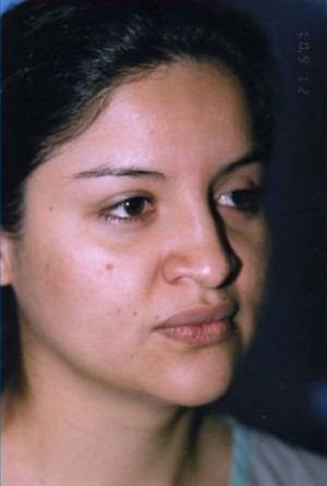 Rhinoplasty Before & After Patient #4821