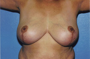 Breast Lift Before & After Patient #5047
