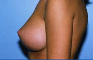 Breast Augmentation Before & After Patient #4962