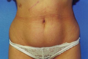 Tummy Tuck Before & After Patient #4904