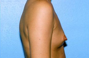 Breast Augmentation Before & After Patient #4969