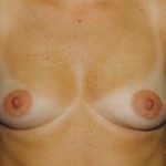 Breast Augmentation Before & After Patient #4993